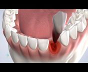 Oral Surgery Specialists of Oklahoma, Dental Implants u0026 Wisdom Teeth