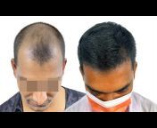 New Roots Hair Transplant Bangladesh