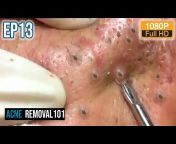 Acne Removal101