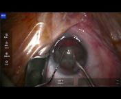 glaucoma surgery