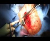 Operation of AC joint, result of a DH crash. Music by Illusion art.nWarning: graphic material!
