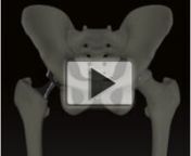 There has been a lot of buzz about the DePuy Hip Replacement Implant Recalls, but few visual aids are available to help people understand the mechanism behind the implant failure.nnIn order to provide attorneys and physicians with the tools needed to help explain this effectively to the people with these implants and their families, MediVisuals has created the Metal-on-Metal Hip Replacement Recall Animation Series. The first of this series focuses on 1. the metal on metal wear and 2. how placeme