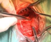This video, recorded in Ninewells Hospital in Dundee, shows the procedure of atticotomy carried out by Mr Muhammad Shakeel.