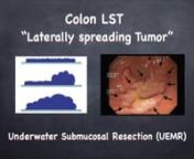The abbreviation LST means “Laterally Spreading Tumors”. They are flat colon lesions, larger than 10 mm, which tipically extends laterally rather than vertically. Because of the flat appearance, they are very difficult to be detected in colonoscopies. But, new scopes with better image quality can make the difference. nMost ofthe LSTs are serrated lesions with high mitotic index and fast progression to adenocarcinoma, that’s why they always need to be resected. However, because they are f
