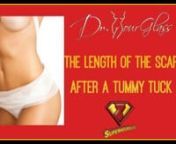 Every single patient that comes to the clinic is extremely concerned about the length of the scar after a tummy tuck. As a matter of fact, one of the first things that they ask for when we start a conversation is a mini tummy tuck, rather than a traditional tummy tuck. Usually, the scar of the tummy tuck goes from hip to hip, which is the standard when it comes to tummy tuck scars. The reason is that most people’s skin has been stretched significantly in all quadrants of the abdomen (i.e. uppe