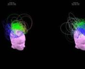 This video shows a comparison of modular decomposition of theta band networks (4-8 Hz) in a comatose patient during two recording sessions at 8 days (left) and 12 days (right) post traumatic brain injury. Despite his poor behavioural responsiveness early after the injury (CRS-R score of 2 during both sessions), this patient regained full behavioural awareness (CRS-R = 20) two months after injury.nnEach frame depicts the network corresponding to 10 seconds of data. One second of video corresponds