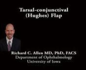 This is Richard Allen at the University of Iowa. This video demonstrates the use of a tarsoconjunctival or Hughes flap to repair a lower eyelid defect.As is noted, the defect is full-thickness and involves approximately 75% of the width of the lower eyelid.The defect is measured with calipers.A subciliary incision is then made extending from the lateral edge of the defect to the lateral canthus.Dissection is then performed between the orbicularis muscle and the orbital septum to the infe