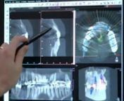 Today, I wanted to show you an example of how helpful a CT scan can be, because we&#39;re going to do this routinely every time we&#39;re going to do a dental implant or a wisdom tooth extraction or a root canal so that we have all the guesswork removed from the game plan. We always want to know what we&#39;re doing before we do it, obviously.nnSo I&#39;ve got this case pulled up because it&#39;s a really nice variety showing how useful this machine is where I was doing this scan originally so that I could plan whe