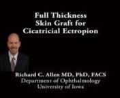 This is Richard Allen at the University of Iowa.This video demonstrates repair of cicatricial lower lid ectropion with a full thickness skin graft.A subciliary incision has been made to release the area of anterior lamellar deficiency.Additional dissection is performed to release the lower lid completely so that it can be freely mobilized superiorly.As with almost every lower lid malposition, horizontal tightening will be performed. In this case, a lateral tarsal strip is fashioned, diss