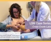 In Case 1.4, the patient demonstrates an incorrect latch technique. The clinician shows the patient how to achieve an asymmetric deep latch in the cross-cradle breastfeeding position.nnClick here to watch Case 1.5: Hand Expression of Breast Milknhttps://www.youtube.com/watch?v=M2_F4FTESBInnVisit us at https://liquidgoldconcept.com/ to learn more about the Lactation Simulation Model