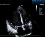 Paced-with-severe-dilated-cardiomyopathy-A4C from cardiomyopathy dilated