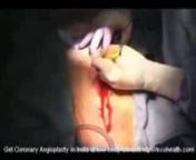 CABG Coronary artery bypass from get plastic surgery for free