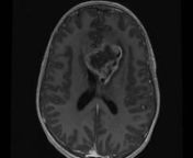 13 yo M with PMHx notable for neurofibromatosis type 1, adrenal insufficiency, short stature, ADHD, developmental delay, and migraine presents with 2 weeks of persistent, unrelenting headache. nnHead CT without contrastnAx - 0:00nnBrain MRI w/wo contrastnDWI - 0:44nADC - 1:32nAx T2 - 1:56nAx T2 FLAIR - 2:20nSWI - 3:11n3D ASL - 4:17nAx T1 pre - 5:17nAx T1 post - 5:41nAx 3D FSPGR post - 6:05nSag T1 post - 8:29nCor T1 post - 8:53nCor T2 - 9:19nnLumbar Spine MRI w/wo contrastnSag T2 - 9:45nSag STIR
