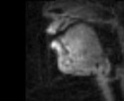This video illustrates real-time MRI of vocal performance.It includes examples from a soprano and an emcee/beatboxer.This video was featured at theSounds and Visions Session, of the International Society for Magnetic Resonance in Medicine (ISMRM) Scientific Sessions, May 2006, Seattle.nnFor more information, visit http://sail.usc.edu/span
