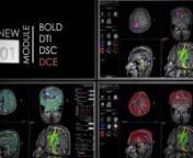 NordicNeuroLab presents nordicBrainEx, now also with Dynamic Contrast Enhanced perfusion. By adding the DCE module to the already existing BOLD fMRI, DTI and DSC, we have made nordicBrainEx even more powerful.