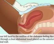 Postpartum IUD Insertion Animation Video (GLOWM) from iud