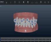 Watch this short demonstration of the various features included with the new Six Month Smiles CONFIDEX.Now included with every aligner case.