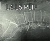 De zieke tussenwervelschijf L4-L5 wordt volledig verwijderd.