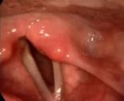 Watch a video of vocal cord paralysis before repair. Note the persisting gap between the vocal cords as they try to close.