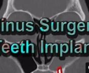 http://www.NoseSinus.comnnhttps://www.google.com.sg/maps/place/...nn3 Mount Elizabeth, #07-02, Mount Elizabeth Medical Centre, Singapore 228510nnDr Kevin Soh describes a case of sinusitis and sinus infection after titanium teeth dental implant. Functional endoscopic sinus surgery (FESS) was performed. nnIf you have any comments, PLEASE do not be afraid to ask. Please SUBSCRIBE, SHARE, and COMMENT on this video.nnIf you prefer to read, rather than watch the video, here’s the transcript.nn0:13 