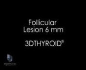 Follicular Lesion 6 mm nThis video clip represents the left thyroid lobe. The 3DTHYROID technology allows the image to be rotated to see the entire left thyroid lobe, the carotid artery and the jugular vein. The carotid artery and the jugular vein are the dark areas on right of the ultrasound. These carry blood to and from the brain. In the upper corner of the left thyroid gland, there is a dark lesion. This dark lesion is a 6 mm follicular lesion.