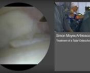 Ankle Arthroscopy: Arthroscopic Treatment of a Tailar Osteochondral Defect from tailar