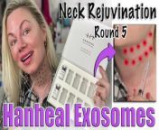 Subscribe!&#60;br/&#62;I love Exosomes and Hanheal makes a great product that is the best priced on the market!&#60;br/&#62;The formula is packed with great ingredients including PDRN, growth factors, peptides, vitamins and more! The neck is an area that deserves the powerhouse formula as its a hard area to treat!&#60;br/&#62;Get you Hanheal Exosomes Here: https://www.acecosm.com/categories/skin-booster/hanheal_exosome&#60;br/&#62;***Code Jessica10 Saves you Money&#60;br/&#62;Note: Code Jessica10 is an affiliate code&#60;br/&#62;&#60;br/&#62;On this channel we talk about LIFE and I share MY OPINION. THIS IS JUST MY OPINION. You can and should speak to a professional and others in your life about any and all things that we discuss on this channel, this is just what I have to say based on my experience. SO do your own research please :)&#60;br/&#62;Join Locals - our Subscription Community (It&#39;s &#36;5 a month): https://wannabebeautygurus.locals.com&#60;br/&#62;&#60;br/&#62;Also email me if you want to be on the daily email blast list, or with questions: jessicajlcameron@yahoo.com&#60;br/&#62;&#60;br/&#62;My Priority Links (Youtube channels, Rumble, Favorite Skin Care and more) : https://qrco.de/bdAMP3&#60;br/&#62;&#60;br/&#62;If you would like to make a donation towards my content, please do so here (there are several ways to do so) but please note that it is not required in any way: https://www.wannabebeautyguru.com/donations&#60;br/&#62;&#60;br/&#62;We have MERCH! Get yours here: https://wannabe-beauty-guru.myspreadshop.com/&#60;br/&#62;&#60;br/&#62;You can see more videos, vlogs and resources for FREE over on my website: https://www.wannabebeautyguru.com (all I ask is when ordering please use my codes, I do get a small kick back and you save &#36;&#36;&#36;&#36; so it&#39;s a win win :)&#60;br/&#62;&#60;br/&#62;Join our facebook Group filled with wonderful, supportive skin care enthusiasts ! https://www.facebook.com/groups/553814011993661&#60;br/&#62;&#60;br/&#62;Join our NEW TO DIY Facebook group: https://www.facebook.com/groups/1626549951146756/&#60;br/&#62;&#60;br/&#62;My Channels - PLEASE SUBSCRIBE and HIT the BELL!&#60;br/&#62;~ Bitchute : https://www.bitchute.com/channel/axSbKNoHdhbj/&#60;br/&#62;&#60;br/&#62;~ Rumble: https://rumble.com/user/WannabeBeautyGuru&#60;br/&#62;&#60;br/&#62;~Discord: Here is the link to join the Discord group! https://discord.gg/bA7Cp9vA7j&#60;br/&#62;&#60;br/&#62;Instagram: https://www.instagram.com/wannabebeautygurujc/?hl=en&#60;br/&#62;&#60;br/&#62;Twitter: https://twitter.com/Wannabebeautyjc&#60;br/&#62;&#60;br/&#62;Things I love :&#60;br/&#62;~ Amazon Store : https://www.amazon.com/shop/influencer-a0791280&#60;br/&#62;~ www.acecosm.com https://bit.ly/3ANGX1Q (where you can buy Korean skin Care and more) ***Use code Jessica10 to save the most money*****&#60;br/&#62;~ www.maypharm.net https://bit.ly/3B4rVoA (where you can buy Korean skin Care , and more) ***Use code Jessica10 to save 13%*****&#60;br/&#62;~ www.glamcosm.com https://bit.ly/2XFdadc (where you can buy Korean skin Care, and more) ***Use code Jessica10 to save the most money*****&#60;br/&#62;~ www.glamderma.com https://bit.ly/2XFdadc (where you can buy Korean skin Care, and more) ***Use code Jessica10 to save the most money*****&#60;br/&#62;~ https://www.platinumskincare.com (where you can buy Peels, after care and more) ***Use code Jessica10 to save 10%*****&#60;br/&#62;~ Plasma Perfecting for your Skin Care devices (including radio frequency microneedling, led lig