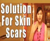#skinscars #darkspots #discoloration&#60;br/&#62;Solution for Skin Scars IIत्वचा के निशान के लिए घरेलु समाधान II By Priyanka Saini&#60;br/&#62;&#60;br/&#62;In this video our very talented, beautiful TV and Movie Actress &amp; Heath &amp; beauty Expert Mrs Priyanka Saini is telling &#92;