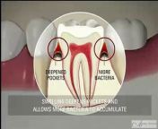 Cleaning (Scaling) teeth and maintenance - An Ashton Avenue, Claremont based disease treatment provider offer quality periodontal teeth treatment services at affordable rates. Visit: http://ashtonavenuedental.com.au/dental-service/cleaning-scaling-and-maintenance